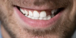 close-up smile showing natural teeth after dental implant treatment