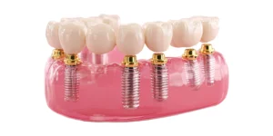 3d illustration of full mouth dental implants supporting a full arch prosthesis