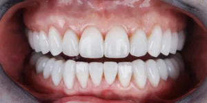 Natural-looking aesthetic dental results with balanced tooth shape, colour, and alignment