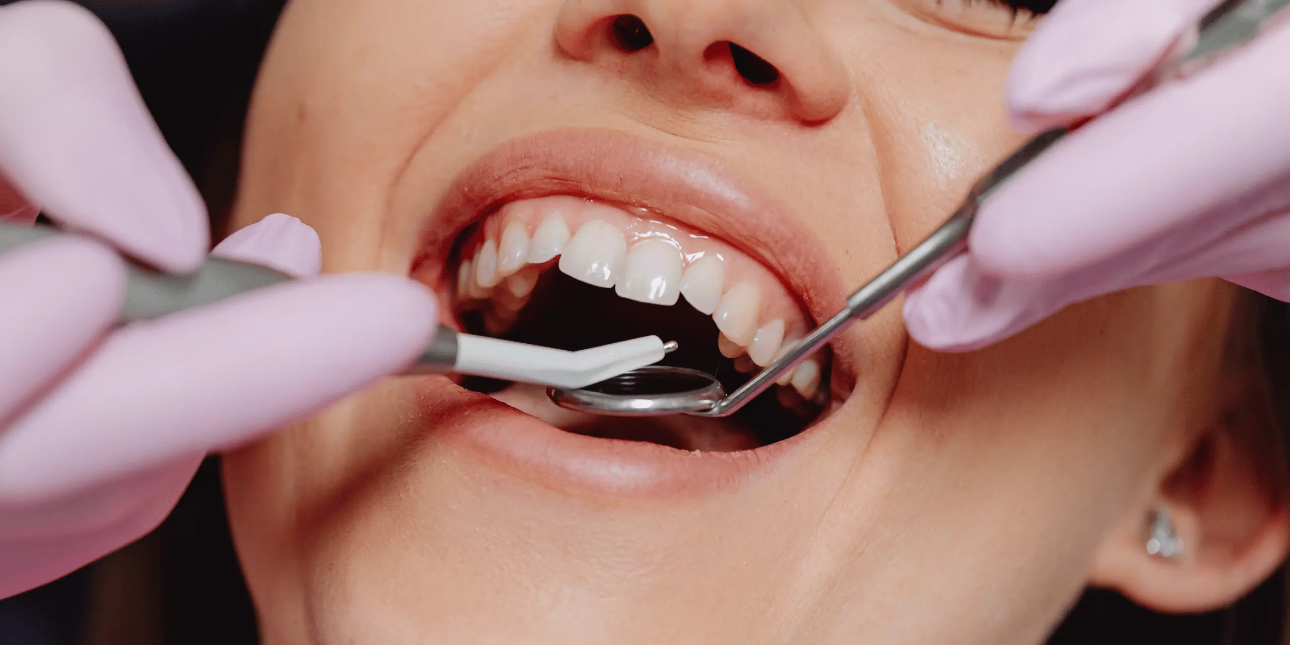 Root Canal Treatment in Turkey: Pain-Free Solutions for Tooth Infections