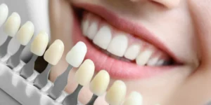 Professional teeth whitening in Turkey with a dental shade guide