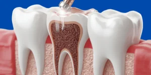 Illustration of root canal treatment removing infected tooth pulp
