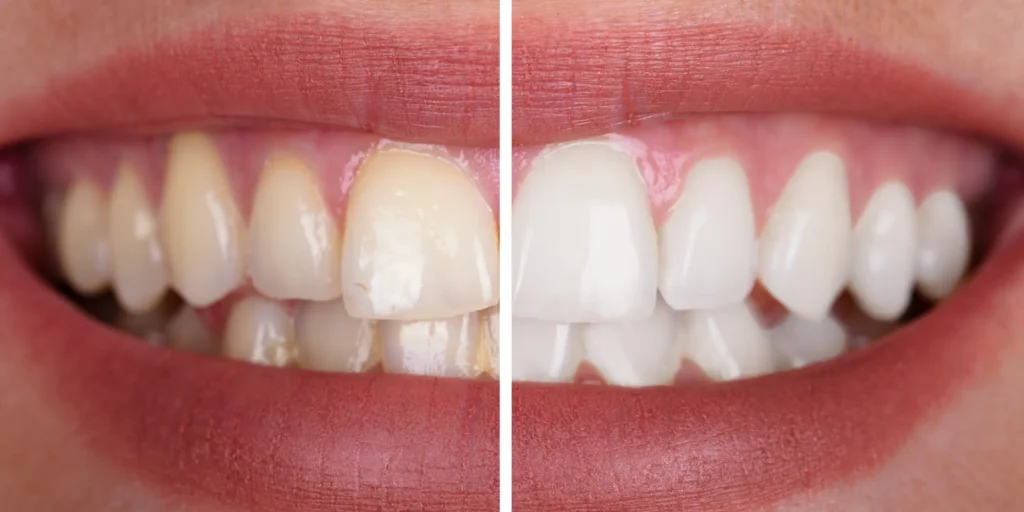 Natural teeth whitening results after professional dental treatment in Turkey